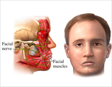 Bell's Palsy