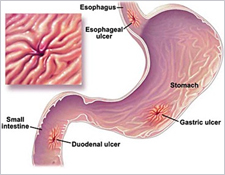 Zollinger Ellison Syndrome