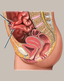 Abdominal-Adhesion