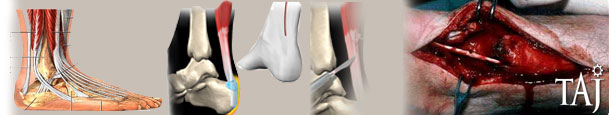 Achilles-Tendon-Injury