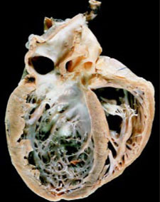 Mild Fibrous Adhesions