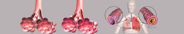 acute_bronchitis