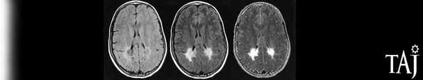 Adrenoleukodystrophy pharma