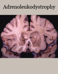 Adrenoleukodystrophy index