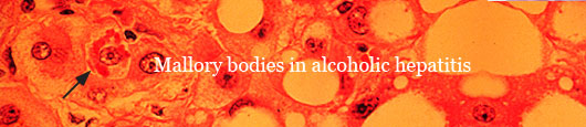 Alcoholic Hepatitis