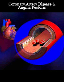 angina pectoris