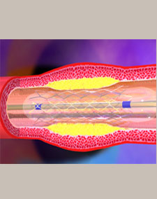 Angioplasty images