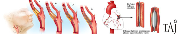 angioplasty