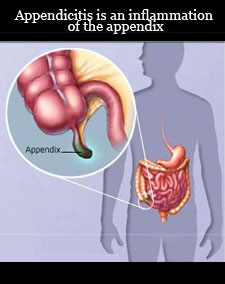 inflammation of the appendix