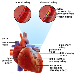 heart-attacts