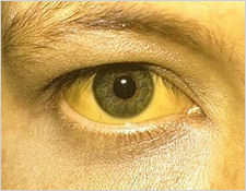 Jaundice Symptoms