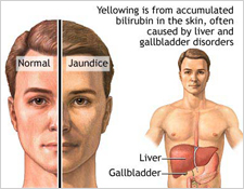 Jaundice Symptoms