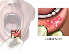 Mouth ulcers