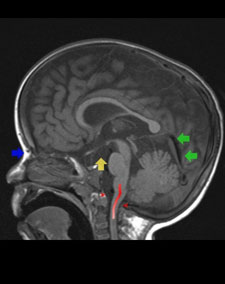 achondroplasia