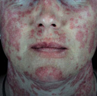 discoid lupus