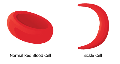 tajpharma sickle cell