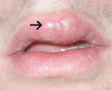 oropharynx Index