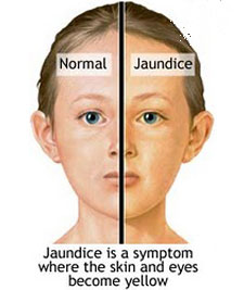 face-cholestatic-jaundice